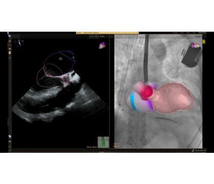 EchoNavigator R4: Heart model with transseptal area visualization