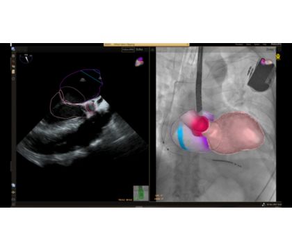 Transesophageal Echocardiogram - Garani Cardiac Centre