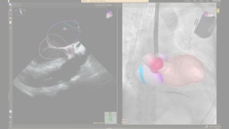 EchoNavigator Live echo and live X-ray fusion tool