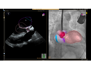Eco navegador Fusionando los rayos X en vivo y el ecocardiograma en vivo