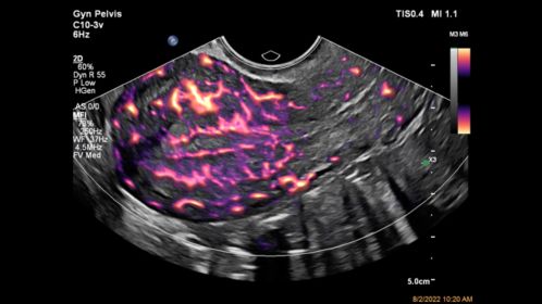 Flow Viewer applied to MFI with C10-3v uterus