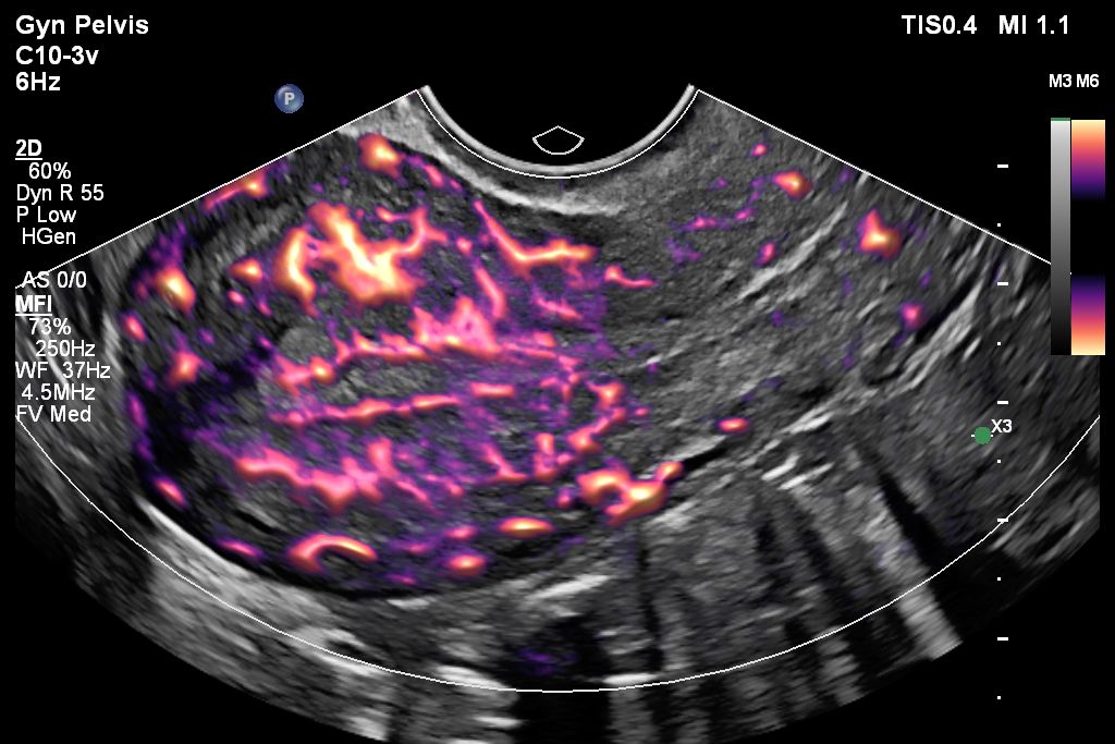 Flow Viewer applied to MFI with C10-3v uterus