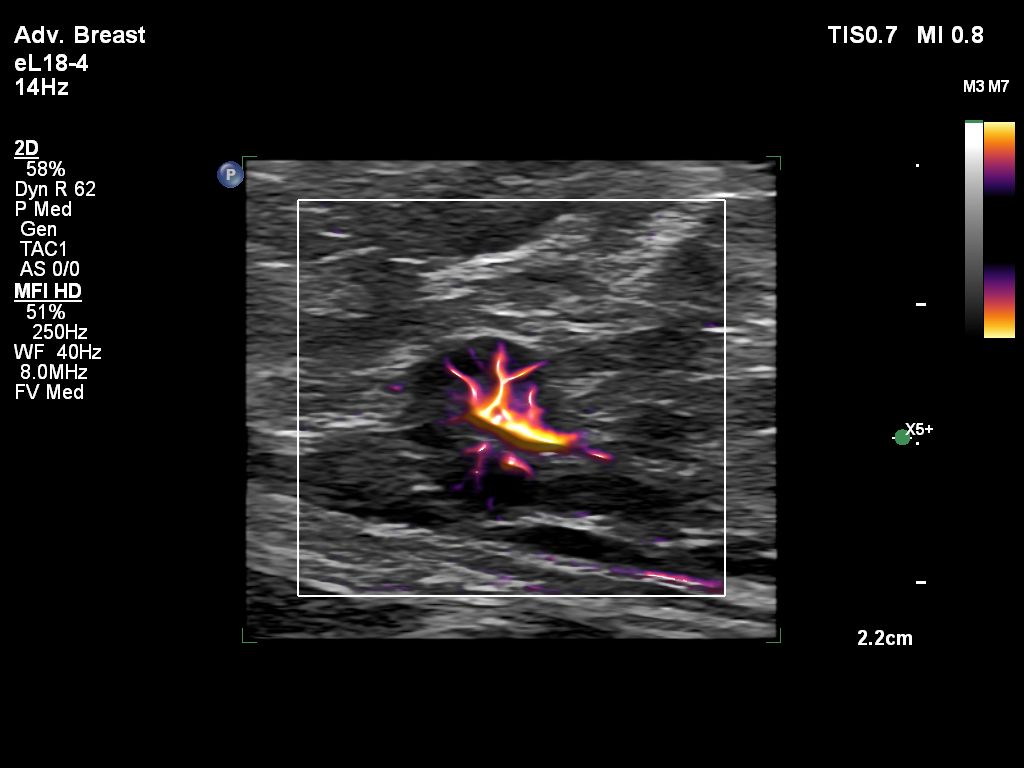 eL18-4 Adv Breast EPIQ MFI HD Lymph Node Axilla
