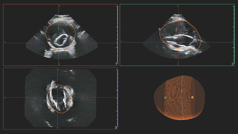 Clinical image of Philips AAA model scan