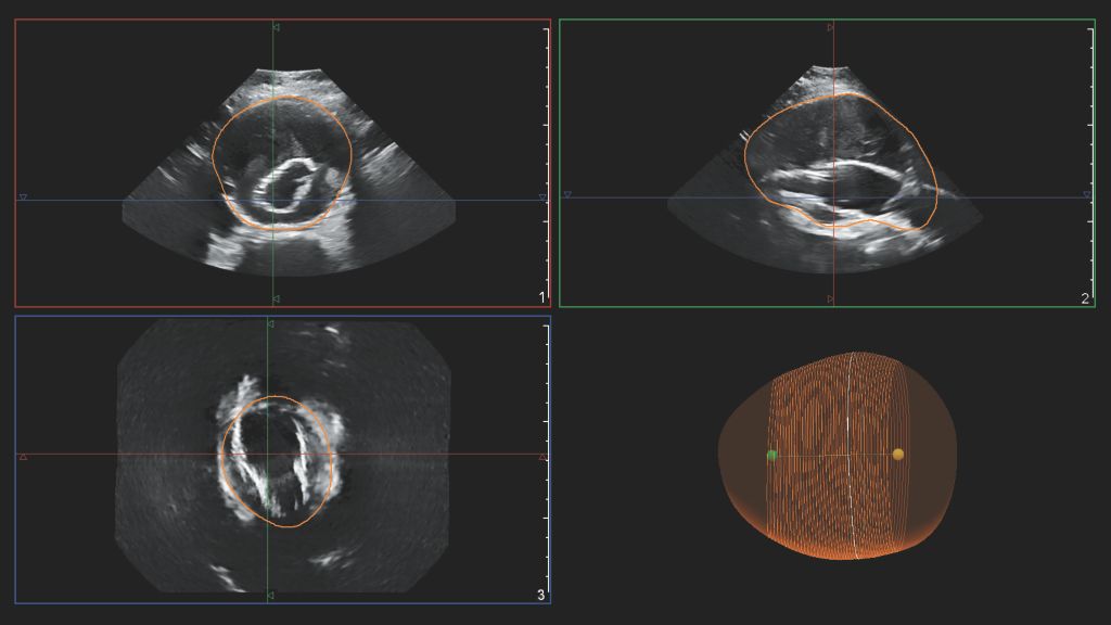 EPIQ utilizing the X6-1 transducer for the Philips AAA model.