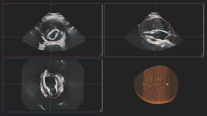 Clinical image of Philips AAA model scan