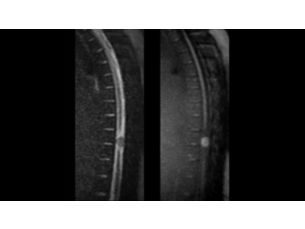 DWI TSE - Spine MR clinical application