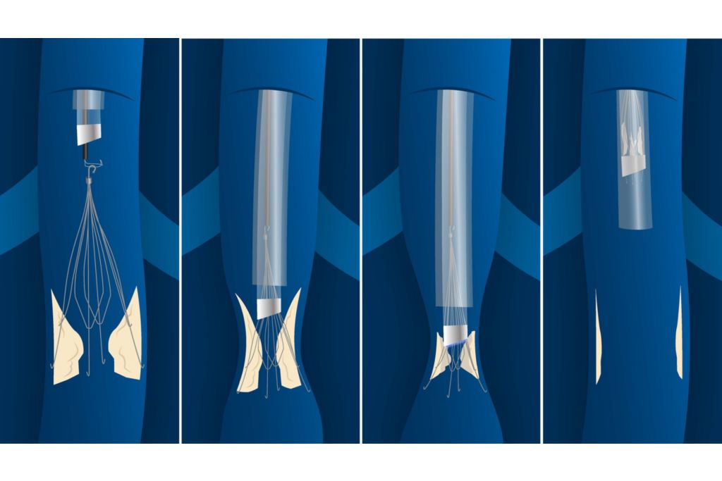 Labs will have access to dedicated Philips representatives to help train staff on device usage and mechanisms of action, as well as offer additional support.