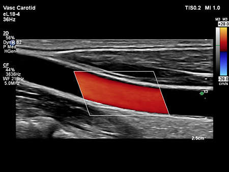 eL18-4 Vascular Carotid