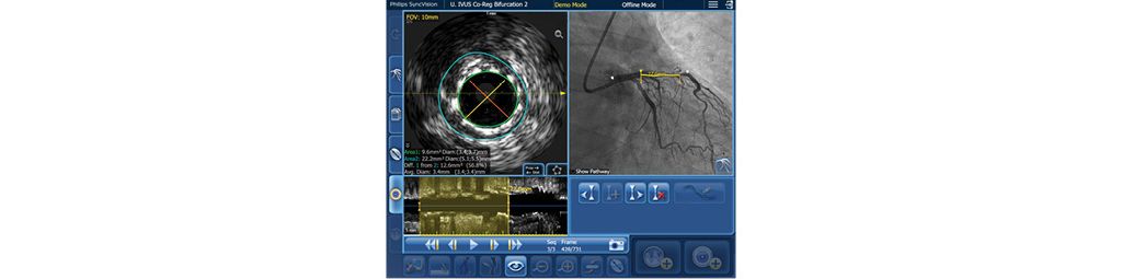 IVUS Co-registration: measurement