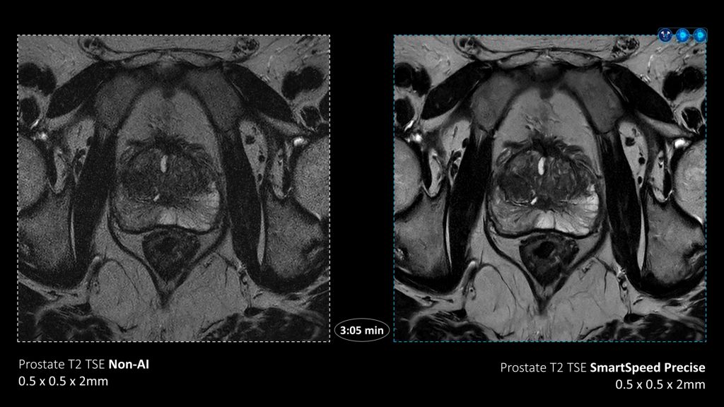 SmartSpeed Precise Prostate comparison with MR 7700

