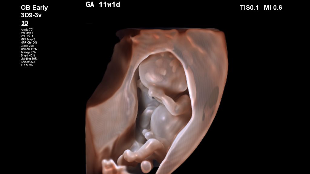 3D TrueVue fetal image using GlassVue and 3D9-3V transducer