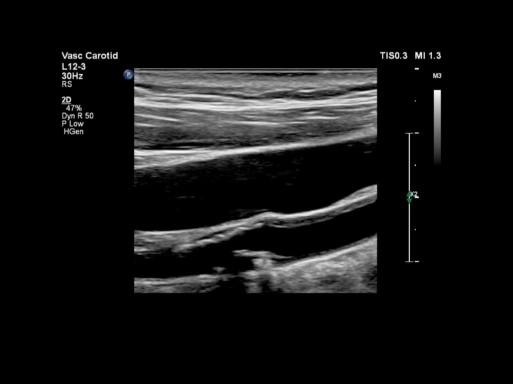 Carotid artery plaque