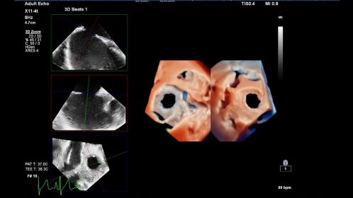 Live 3D TEE TrueVue in Dual Imaging