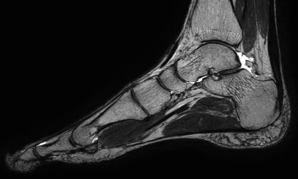 Sagittal 3D VIEW - T2w TSE