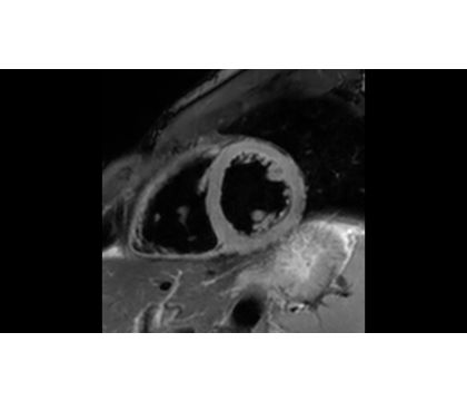 Cardiac MS/QF MR clinical application