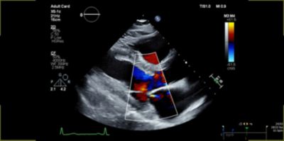 CVx X5-1c PLAX Color Doppler MR