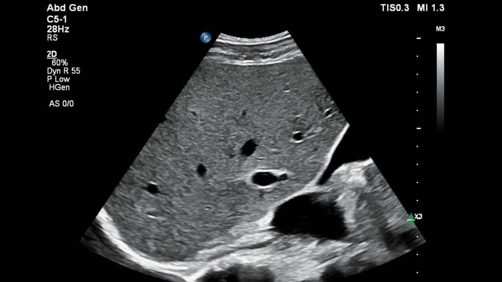 Liver and Gallbladder