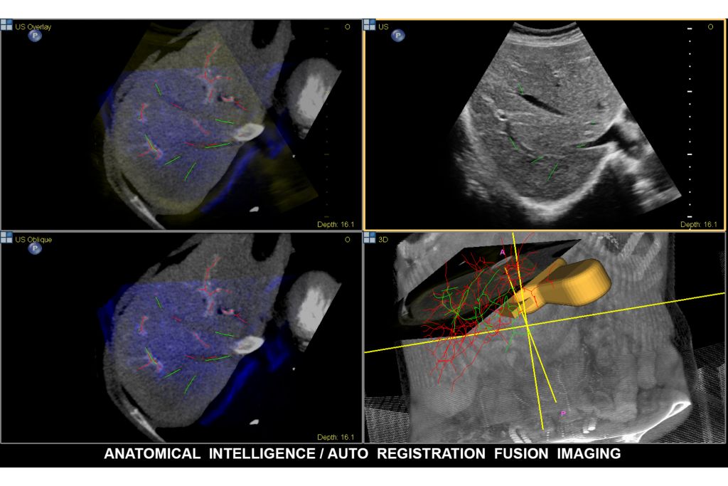Philips Fusion Image, fusion and needle navigation