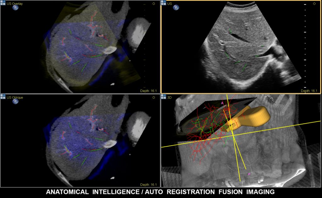 Philips Fusion Image, fusion and needle navigation