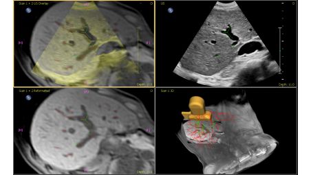 Anatomically Intelligent Ultrasound – KI für schnellere Analysen und höhere Reproduzierbarkeit