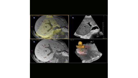 Anatomically Intelligent Ultrasound – KI für schnellere Analysen und höhere Reproduzierbarkeit