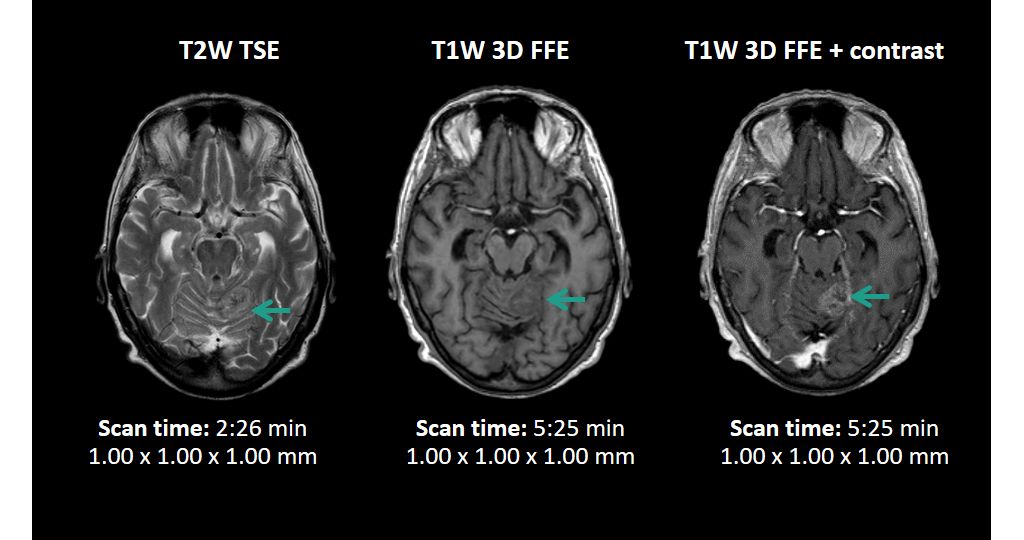 T1W and T2W contrasts - brain
