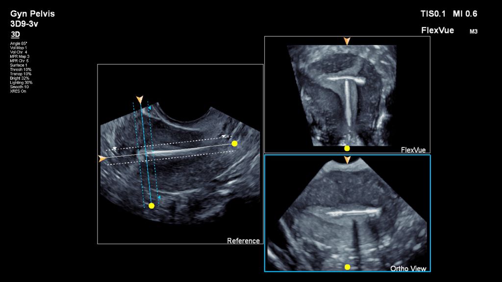 FlexVue with Orthogonal View produces a complete projected coronal view of the uterus with an IUD
