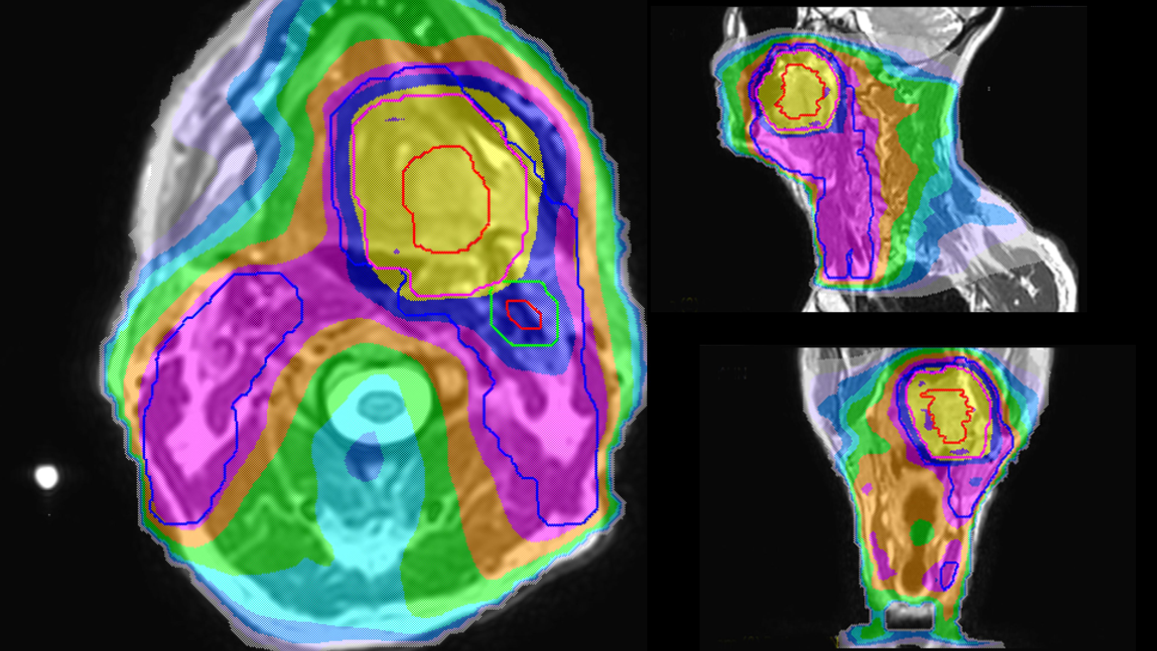 Personalized VMAT dose planned in Philips Pinnacle.  