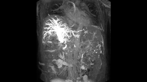 3D MRCP (MIP)