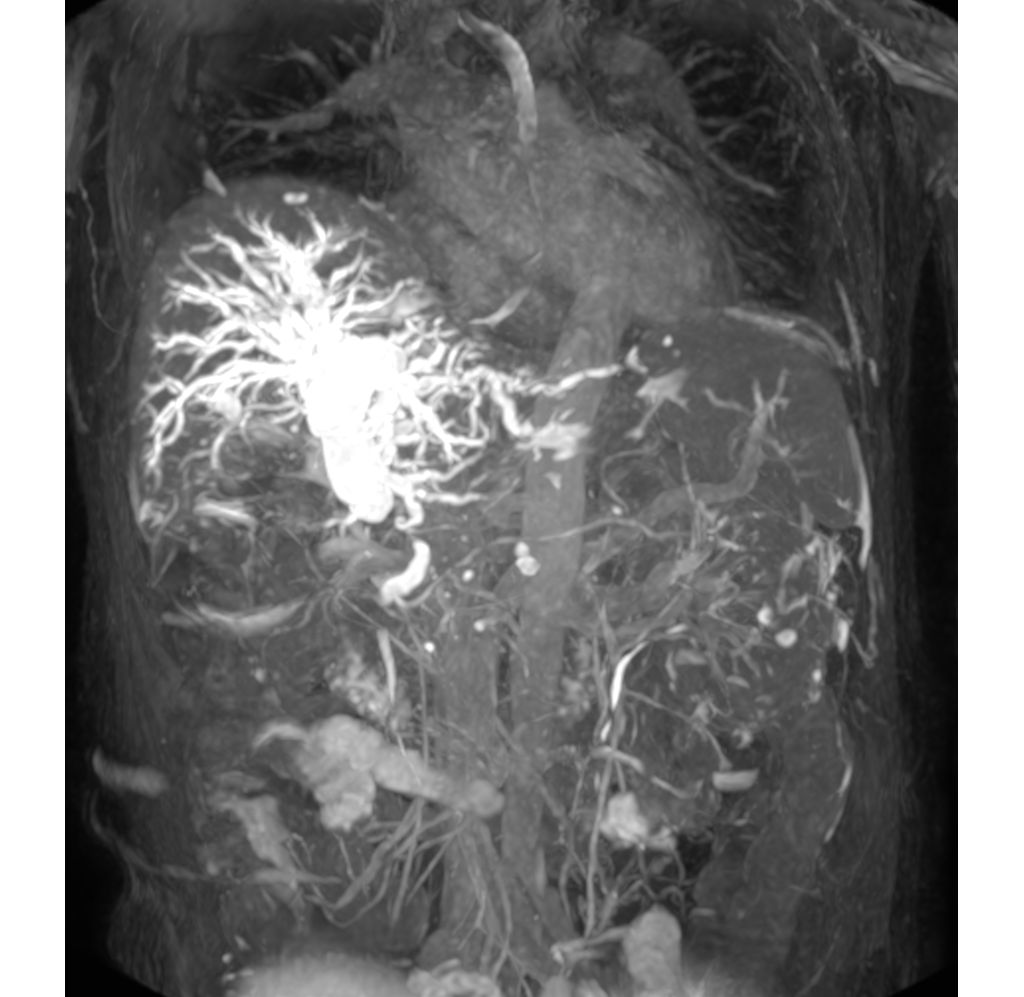 3D MRCP (MIP)