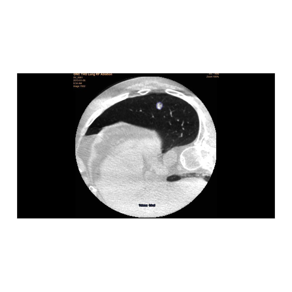 Facilitate successful tumor coverage