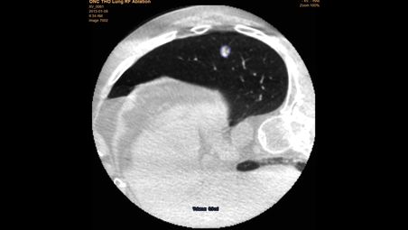 Facilitate successful tumor coverage