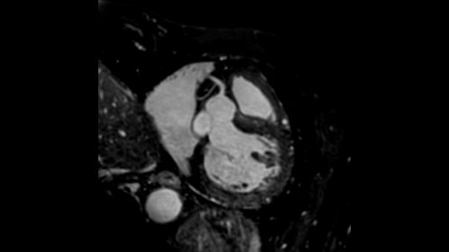 Coronary Acquisition