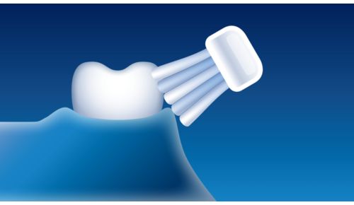 Sicher bei Zahnspangen, Zahnersatz, Veneers