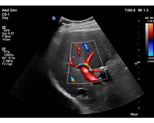 Abd Gen Liver Hep Veins FV Max