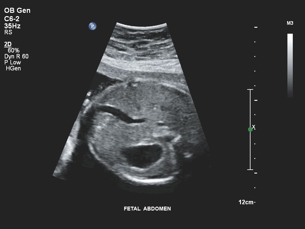 Affiniti 30 ultrasound clinical image obstetric fetal abdomen