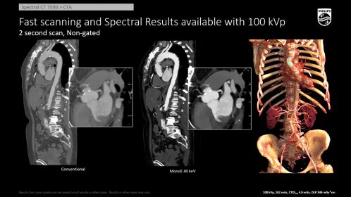 CT Spectral 7500 CAP 100 kVp and Fast scan