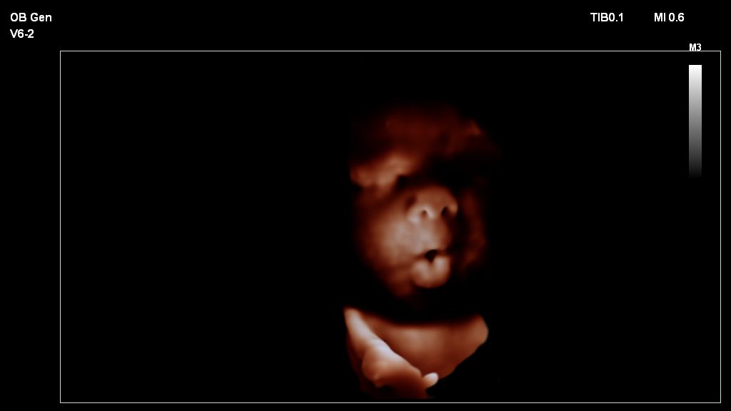 Fetal image shown with TrueVue on V6-2 transducer