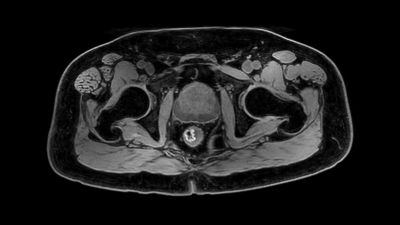 Philips - mDIXON XD FFE - 骨盤 MRクリニカルアプリケーション