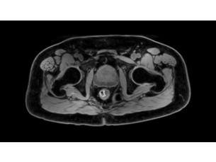 mDIXON XD FFE - Pelvis MR clinical application