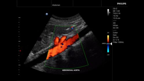 Innosight clinical image abdominal aorta