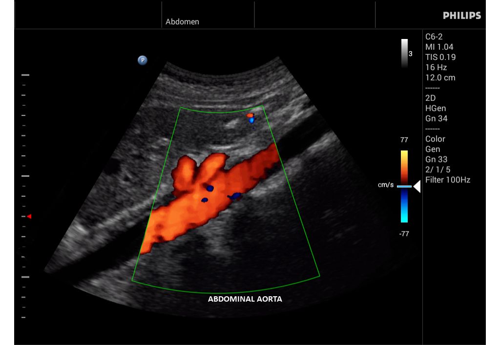 Innosight clinical image abdominal aorta