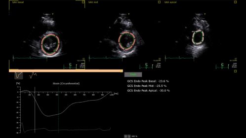 Ultrasound Workspace AutoStrain SAX