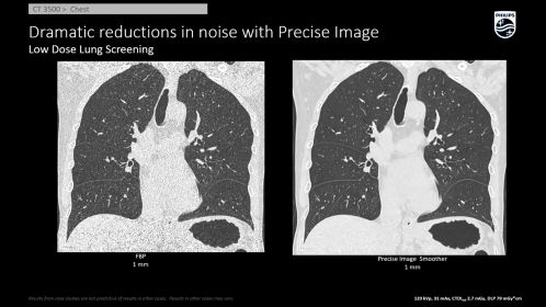 Low Dose Lung Screening AI Recon Precise Image
