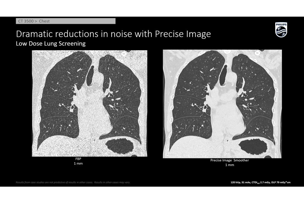 Low Dose Lung Screening AI Recon Precise Image