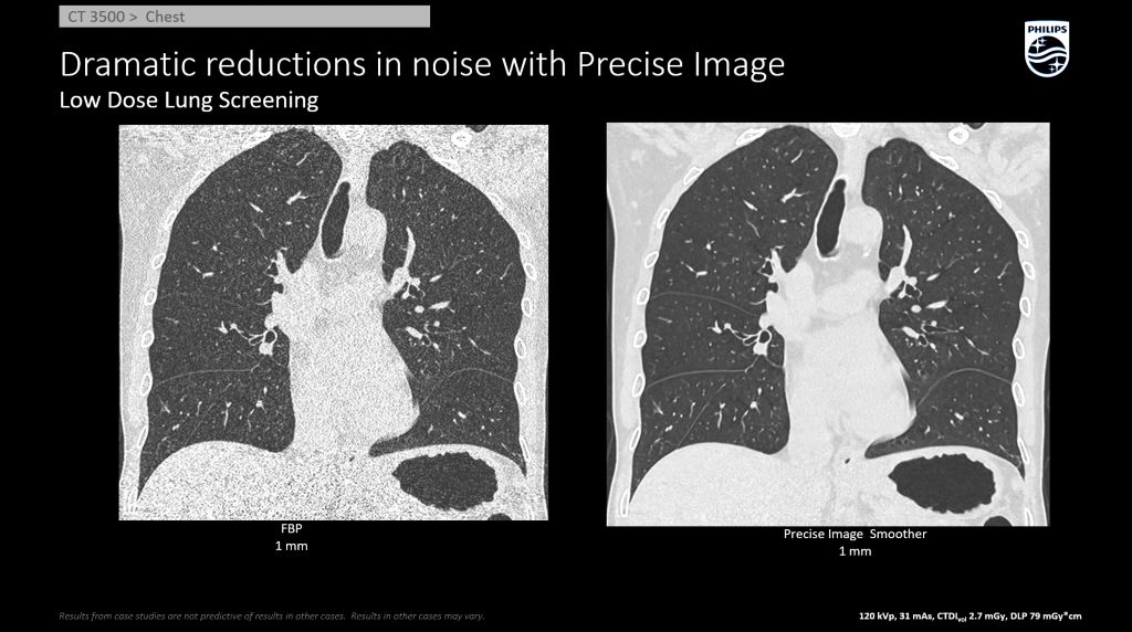 Low Dose Lung Screening AI Recon Precise Image