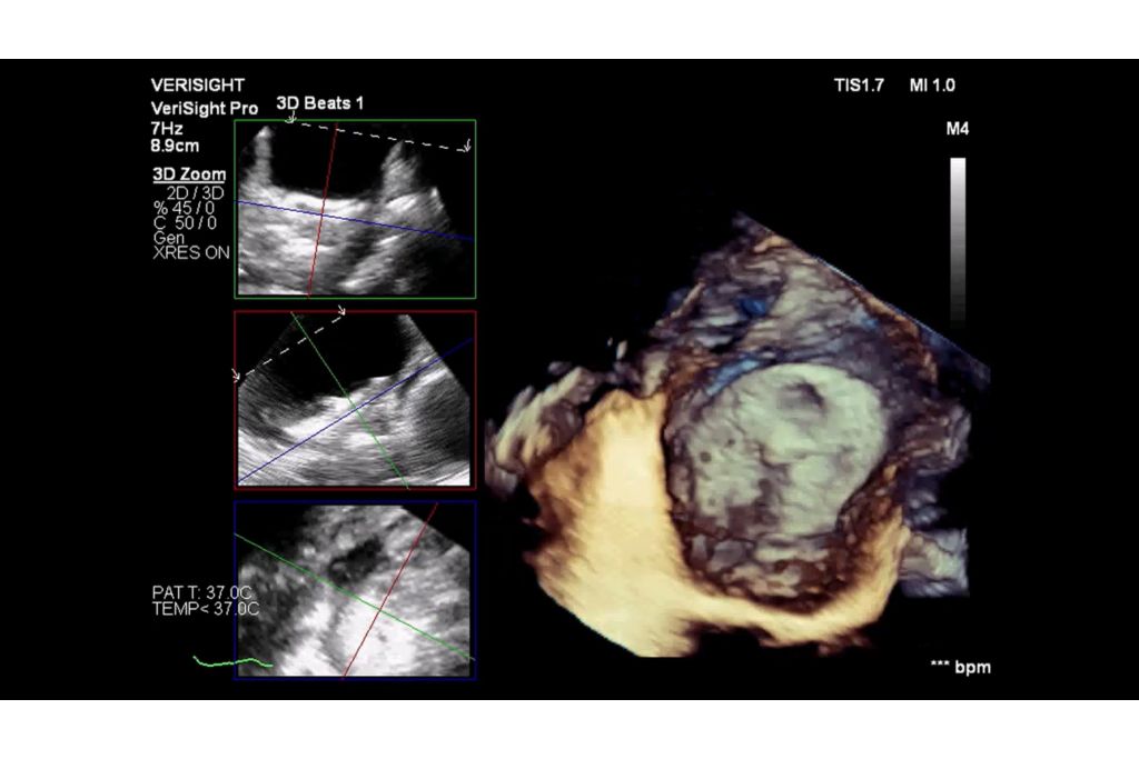 Left atrial appendage occlusion (LAAO) device with MultiVue view