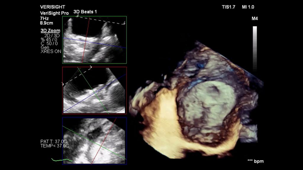 Left atrial appendage occlusion (LAAO) device with MultiVue view