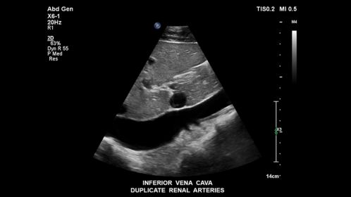 Inferior vena cava duplicate renal arteries